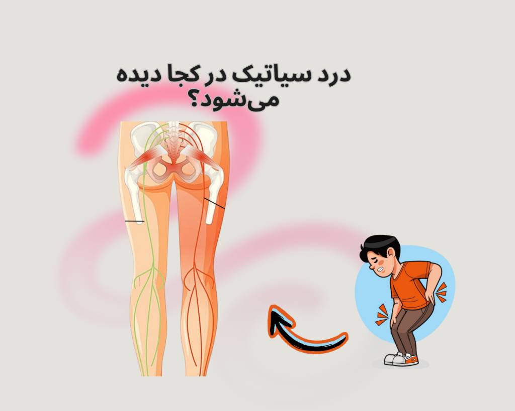 درد سیاتیک در پاها منتشر می شود.