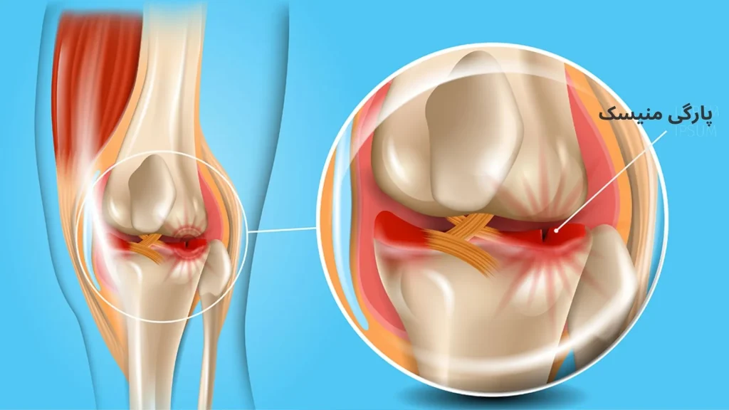 پارگی منیسک زانو 