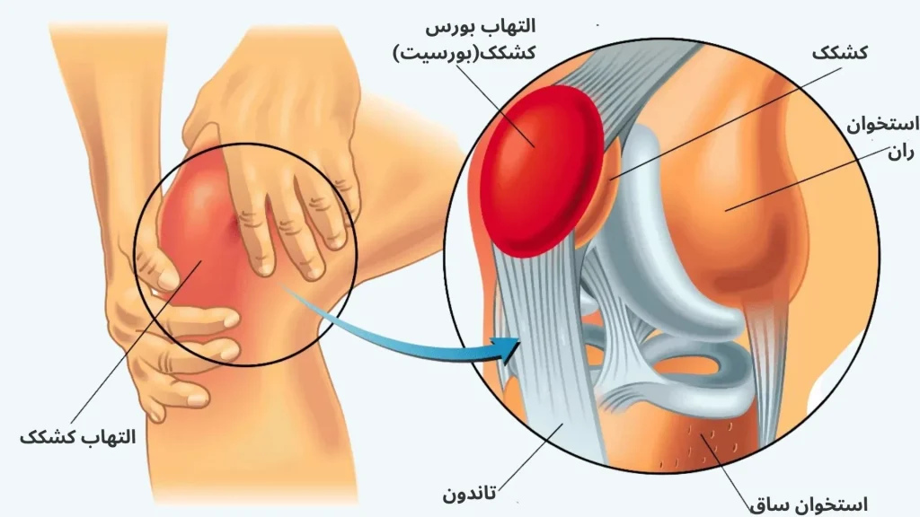 بورسیت زانو