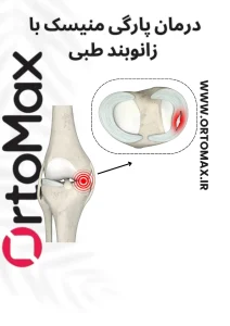 پارگی منیسک زانو