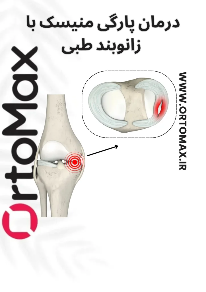 پارگی منیسک زانو