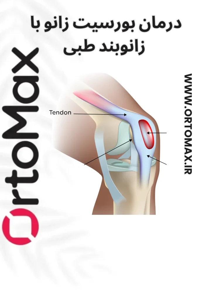 بورسیت زانو و زانوبند طبی پیشرفته