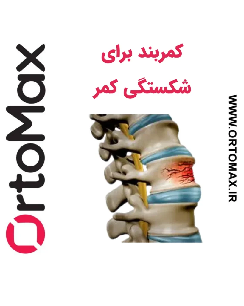 شکستگی کمر