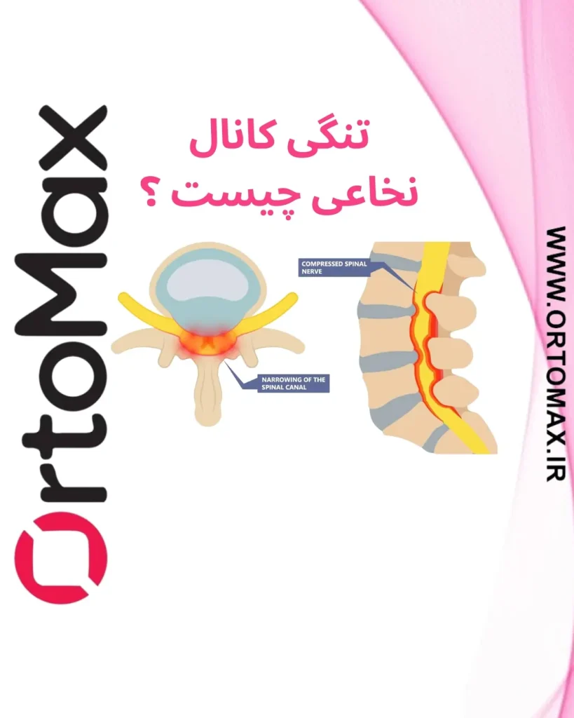 تنگی کانال نخاعی