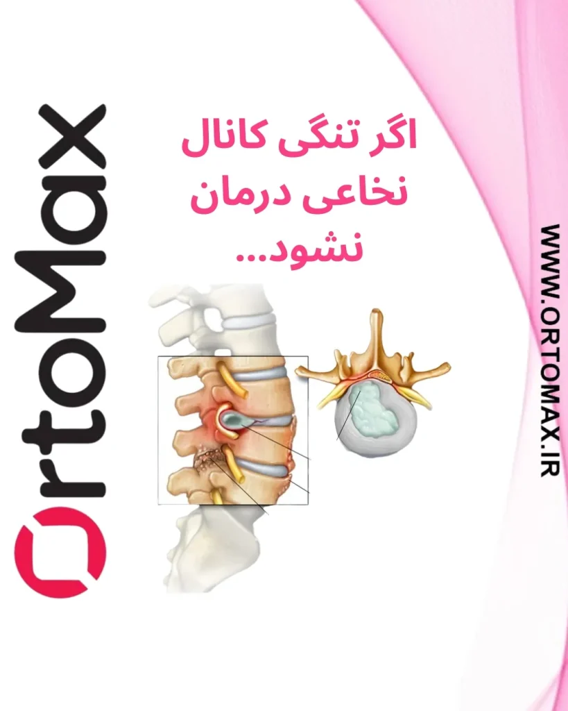 تنگی کانال نخاعی